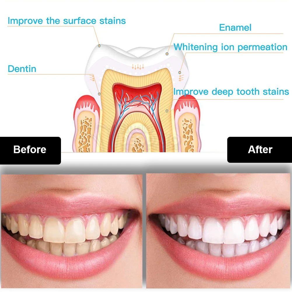 Dental Teeth Whitening Kit Min - Teeth Whitening Ai 评论和价格